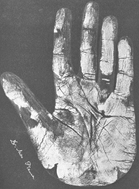 Max Planck hand Dupuytren's contracture